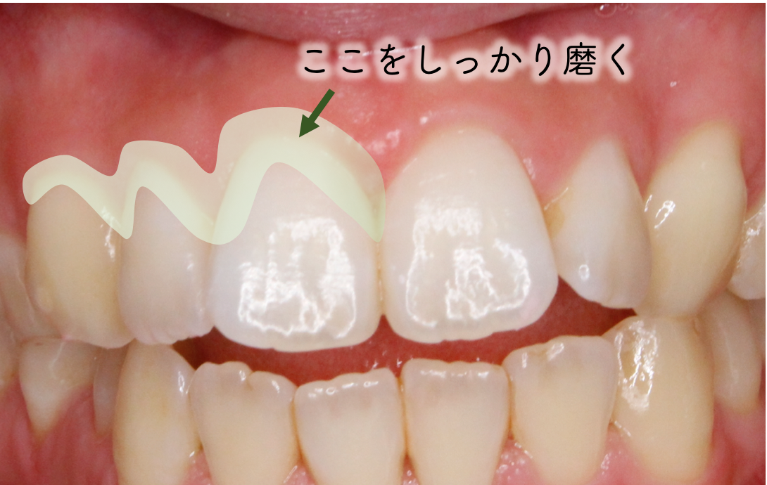 おうちで口腔ケアを 上板橋 板橋区桜川 の歯科医院 Suzuki Dental Clinicー歯科鈴木医院