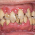 歯周病治療　治療例