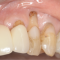 歯肉退縮改善治療（根面被覆）　治療例