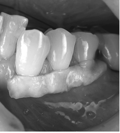 移植　トンネリング