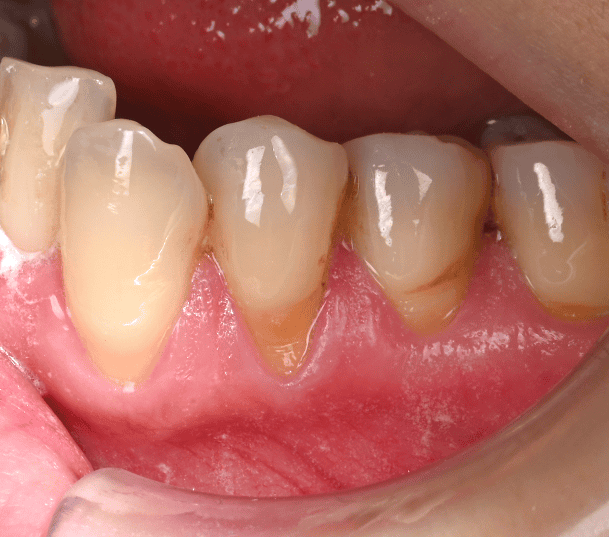 術前　歯肉の下がり